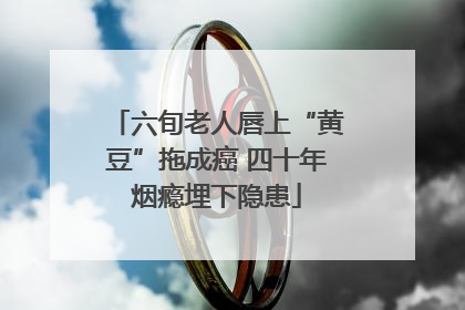 六旬老人唇上“黄豆”拖成癌 四十年烟瘾埋下隐患